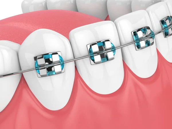 3d renderizado de mandíbula con dientes y ortodoncia — Foto de Stock