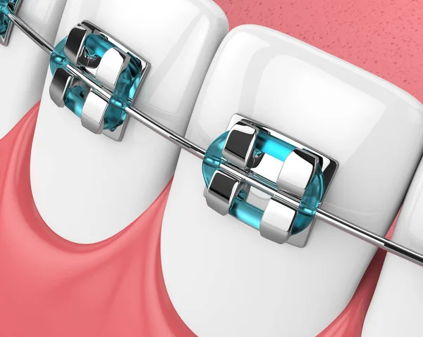 3D činí z čelist se zuby a ortodontická rovnátka — Stock fotografie
