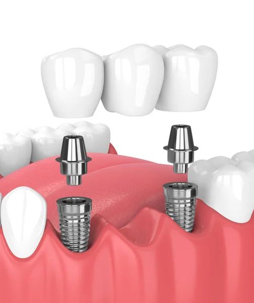 Renderização 3d da mandíbula e implantes com ponte dentária — Fotografia de Stock