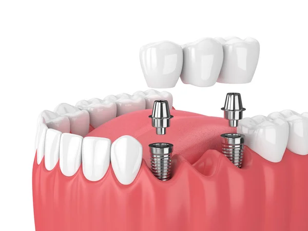 3d render of jaw and implants with dental bridge — Stock Photo, Image