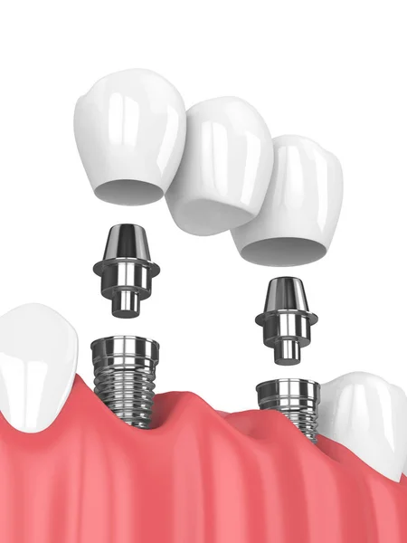 3d renderizado de mandíbula e implantes con puente dental —  Fotos de Stock