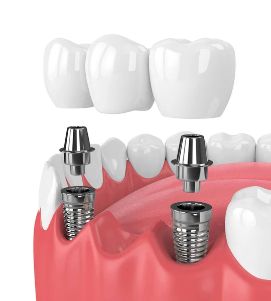 Renderização 3d da mandíbula e implantes com ponte dentária — Fotografia de Stock