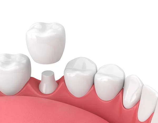 3D render van kaak met tanden en tandheelkundige kroon restauratie — Stockfoto