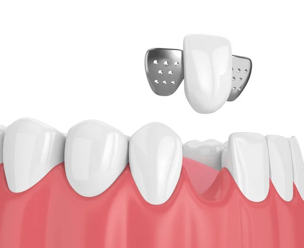 Resa 3d della mascella con denti e ponte del Maryland — Foto Stock