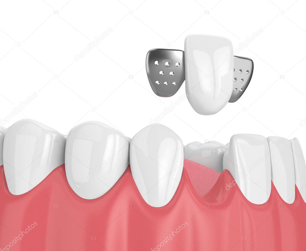 3d render of jaw with teeth and maryland bridge 