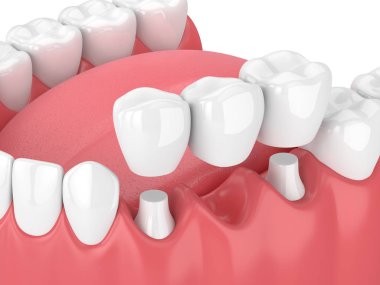 çene diş köprü ile 3D render 