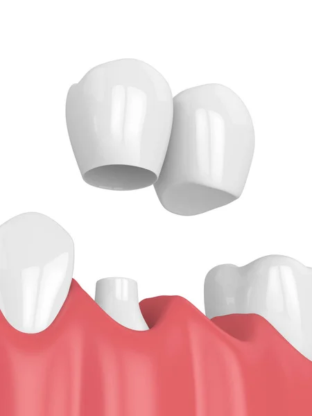 3d renderização da mandíbula com ponte cantilever dental — Fotografia de Stock