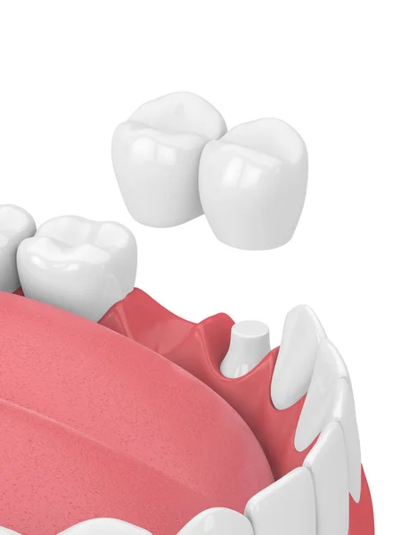 3D činí z čelisti s zubní konzolový most — Stock fotografie