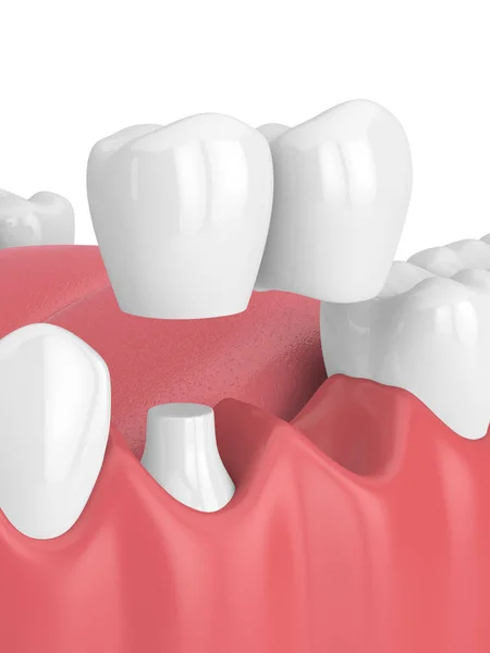 3D render szczęki z dentystyczne mostu wspornikowego — Zdjęcie stockowe