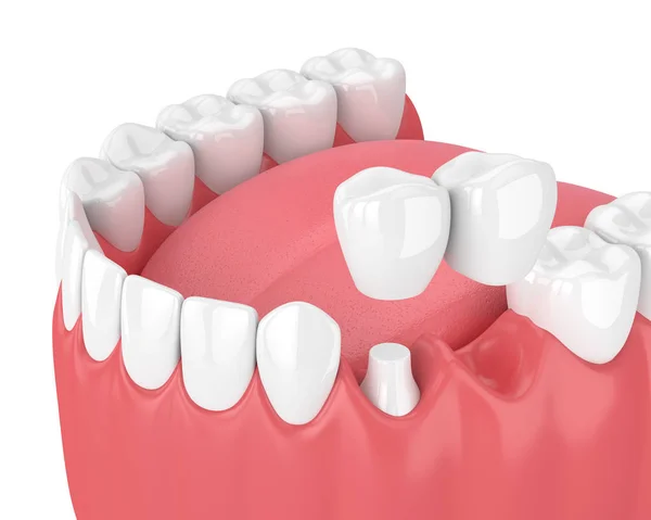 3d renderização da mandíbula com ponte cantilever dental — Fotografia de Stock