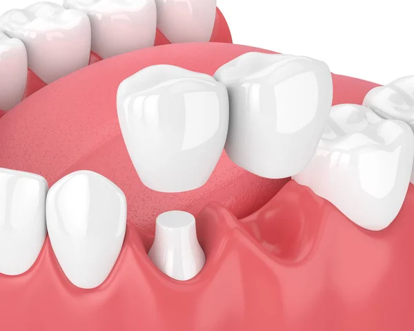 3d renderização da mandíbula com ponte cantilever dental — Fotografia de Stock