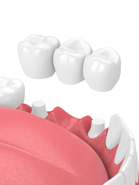 3d render of jaw with dental bridge — Stock Photo, Image