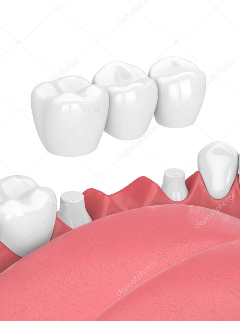 3d render of jaw with dental bridge 