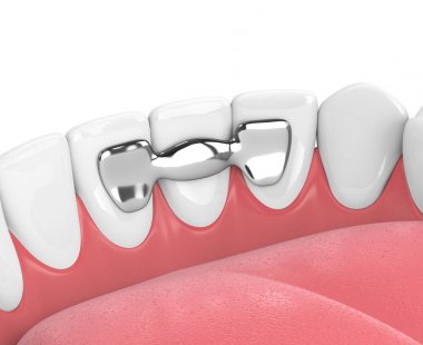 3d render of jaw with teeth and maryland bridge  clipart