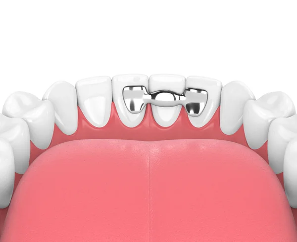 3d render of jaw with teeth and maryland bridge — Stock Photo, Image