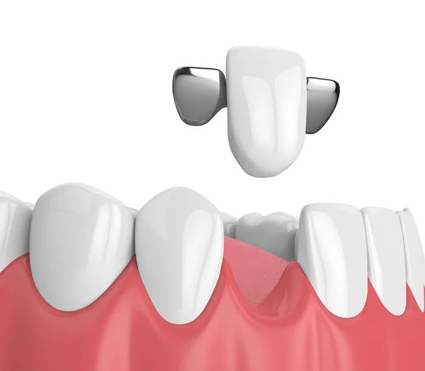 3d renderizado de mandíbula con dientes y puente maryland — Foto de Stock