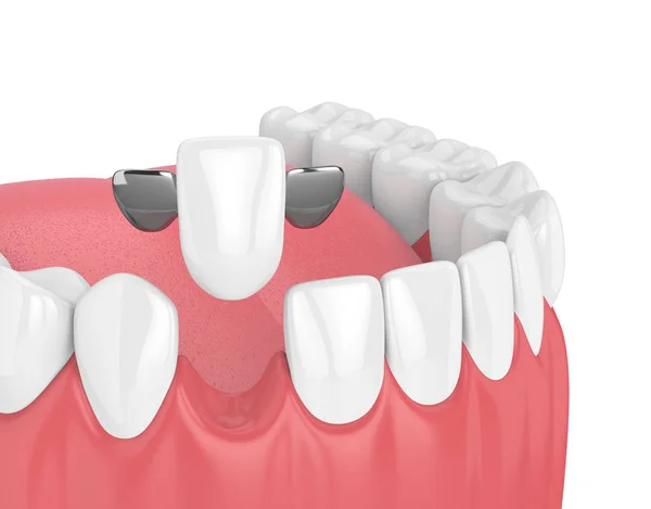 3d render of jaw with teeth and maryland bridge — Stock Photo, Image