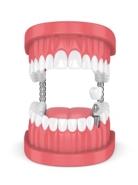 diş ve diş azıdişinde implant çene 3D render