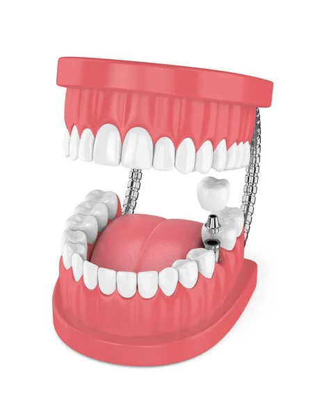 3d render of jaw with teeth and dental molar implant — Stock Photo, Image