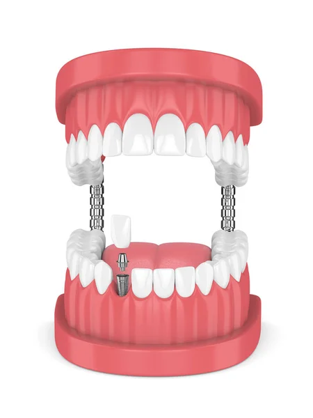 3D render szczęki z implantów dentystycznych siekaczy i zębów — Zdjęcie stockowe