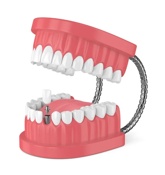 3d render of jaw with teeth and dental incisor implant — Stock Photo, Image