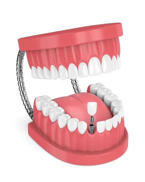 3D render állkapocs, fogak és fogászati metsző implantátum — Stock Fotó
