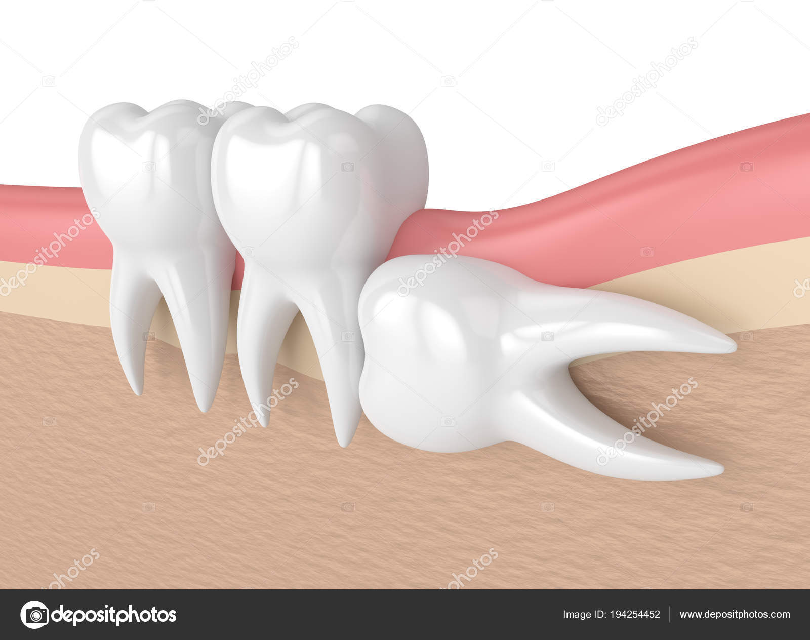 Ретинированный дистопированный зуб мудрости. Горизонтальный зуб мудрости. Лежащие зубы. Третий моляр зуб мудрости. Ретинированный дистопированный зуб мудрости.