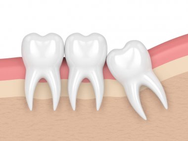 Diş bilgelik mesial sıkışması ile 3D render