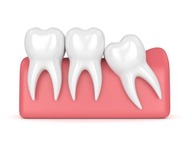 Diş bilgelik mesial sıkışması ile 3D render