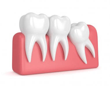Diş bilgelik mesial sıkışması ile 3D render