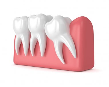 Diş bilgelik mesial sıkışması ile 3D render