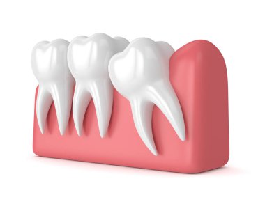 3d render of teeth with wisdom mesial impaction clipart