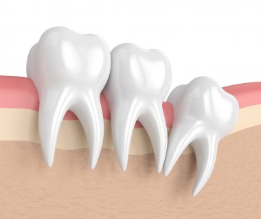 Diş bilgelik distal sıkışması ile 3D render