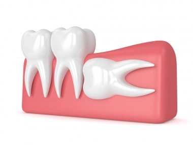 Diş bilgelik yatay sıkışması ile 3D render