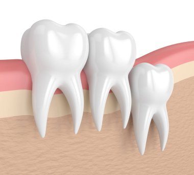 Diş bilgelik dikey sıkışması ile 3D render