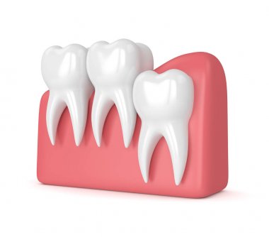 Diş bilgelik dikey sıkışması ile 3D render