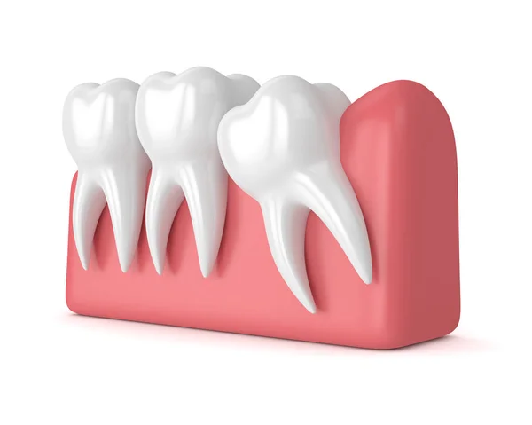 3d render of teeth with wisdom mesial impaction — Stock Photo, Image