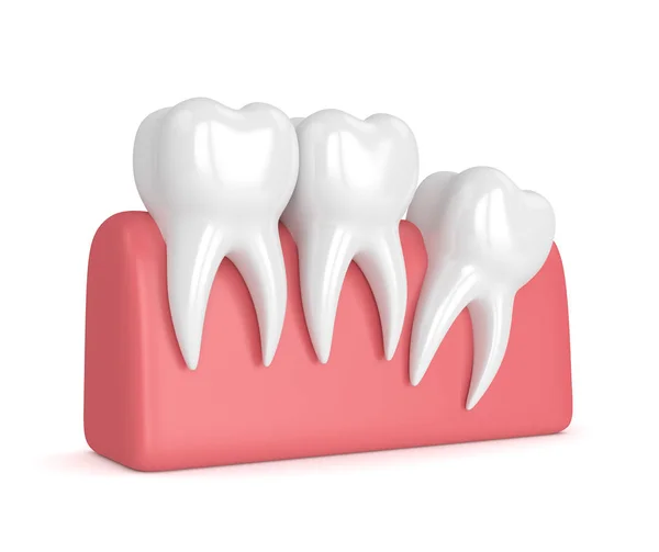 3d render of teeth with wisdom distal impaction — Stock Photo, Image