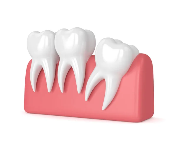 3d render of teeth with wisdom distal impaction — Stock Photo, Image