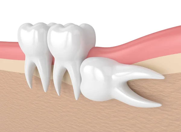 A fogak, a bölcsesség vízszintes impaktáció 3D render — Stock Fotó