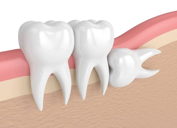 3d render of teeth with wisdom horizontal impaction — Stock Photo, Image