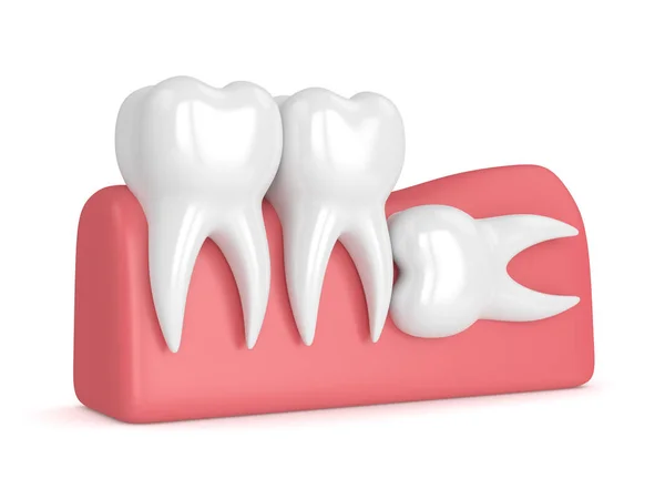 3d render of teeth with wisdom horizontal impaction — Stock Photo, Image