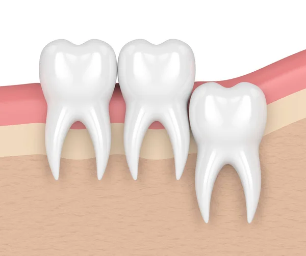 बुद्धि ऊर्ध्वाधर प्रभाव के साथ दांतों का 3 डी रेंडर — स्टॉक फ़ोटो, इमेज