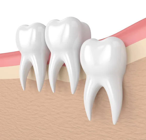 3d render of teeth with wisdom vertical impaction