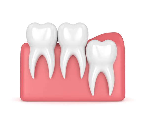 3d render of teeth with wisdom vertical impaction — Stock Photo, Image