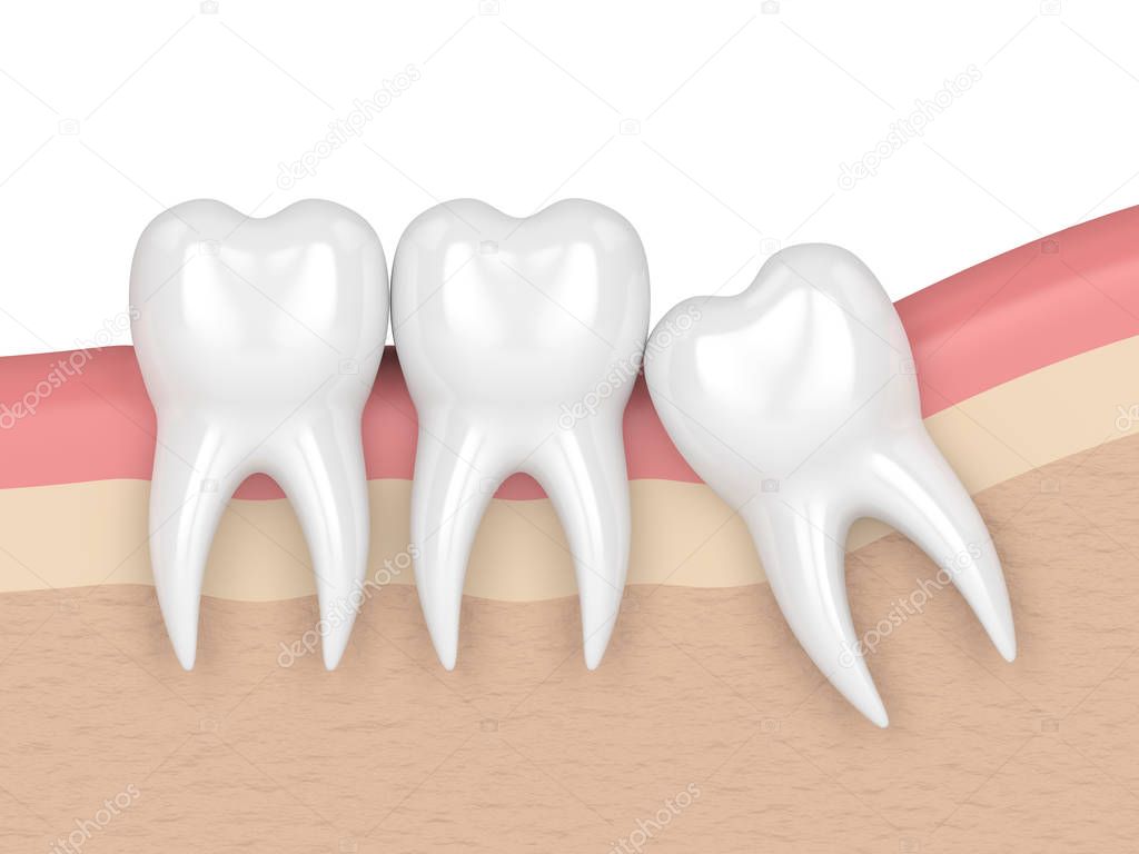 3d render of teeth with wisdom mesial impaction