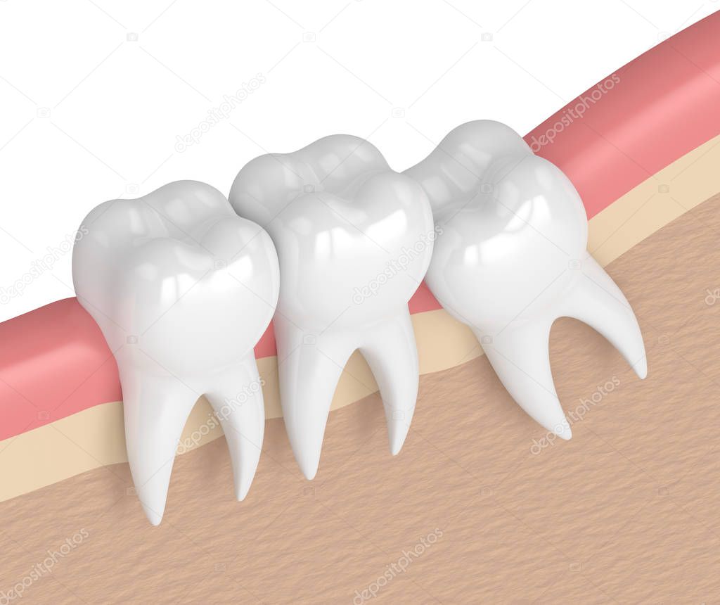 3d render of teeth with wisdom mesial impaction