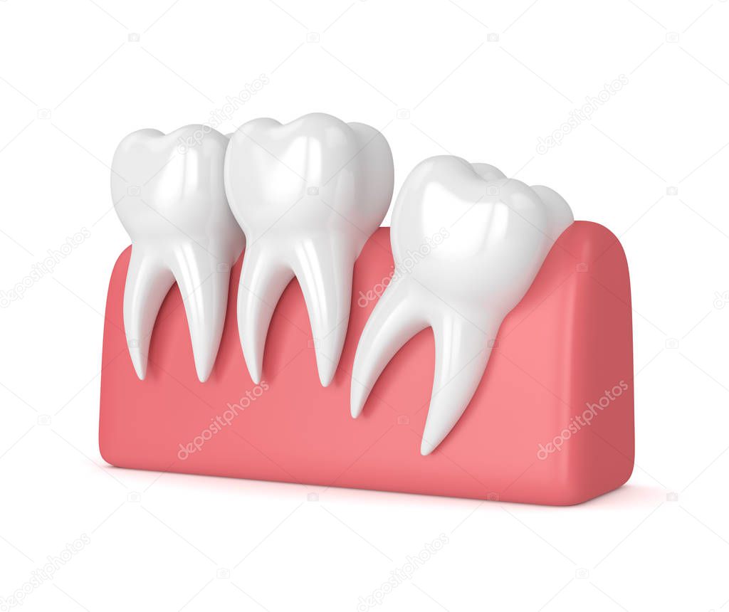 3d render of teeth with wisdom distal impaction
