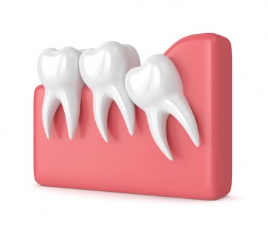 3d render of teeth with wisdom crowding clipart