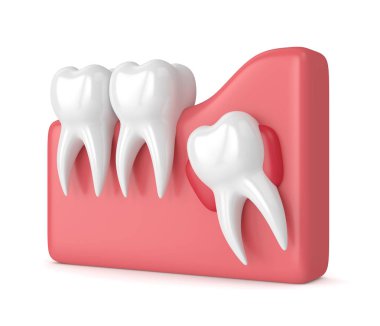 3d render of teeth with wisdom cyst clipart